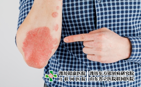 攝圖網_506432486_患有粗俗的牛皮癬濕疹和其他皮膚?。ㄆ髽I商用）