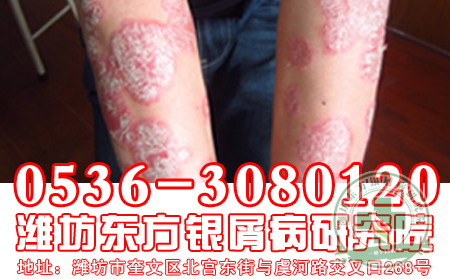 食鹽過多牛皮癬恢復的重大要害嗎？