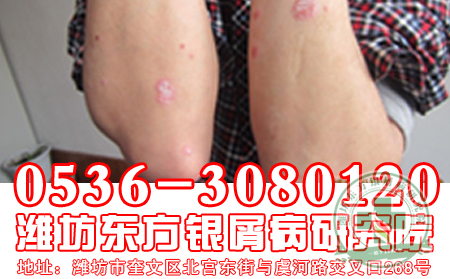 牛皮癬患者在補(bǔ)充營養(yǎng)的時(shí)候是否可使用魚