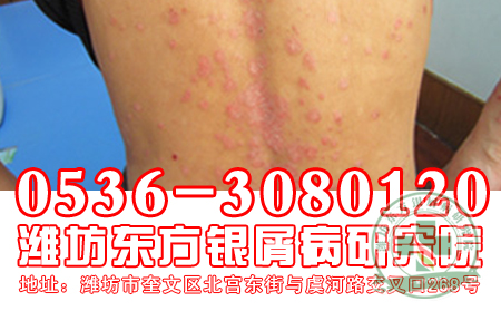 脂溢性牛皮癬患者生活中常見(jiàn)癥狀