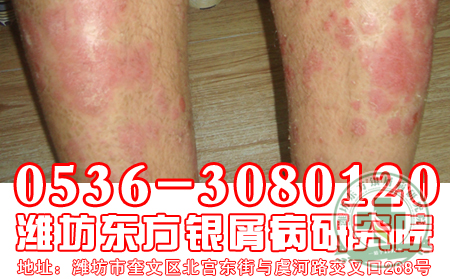 傳染會不會是導(dǎo)致銀屑病發(fā)病的誘因？