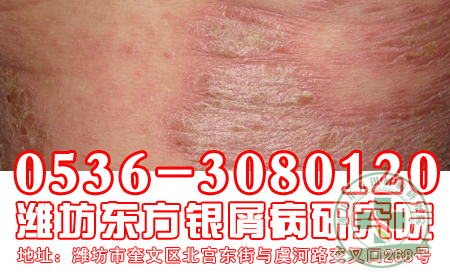造成銀屑病患者發病的誘因有哪些？