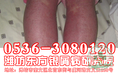 情緒低落會影響牛皮癬病情