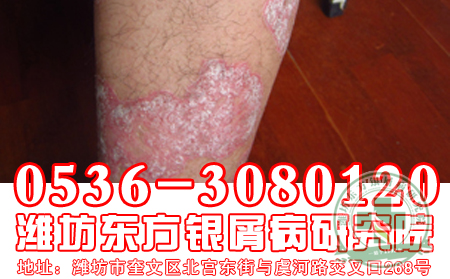 牛皮癬為什么會(huì)癢