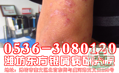 關節型牛皮癬怎么治療？