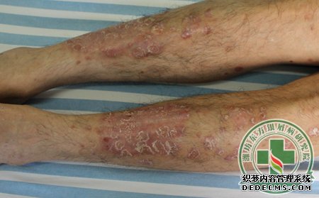 詳細(xì)為銀屑病患者介紹不同的銀屑病癥狀表現(xiàn)