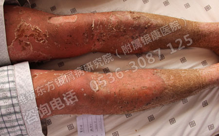 尋常型牛皮癬轉(zhuǎn)型后會(huì)造成什么樣的危害