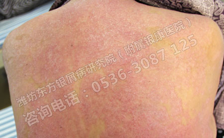 為什么治療銀屑病需要到濟南銀屑病醫(yī)院