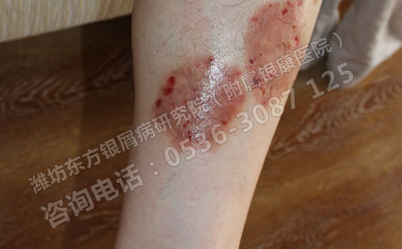女性銀屑病的容易復發的原因是什么