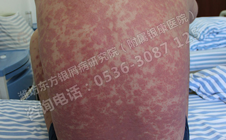 銀屑病的發(fā)生會給人體造成哪些危害