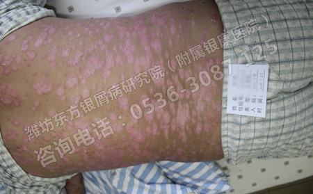季節交替銀屑病患者要注意哪些飲食問題