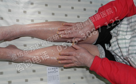 如何防止銀屑病在急性進行期泛發全身呢