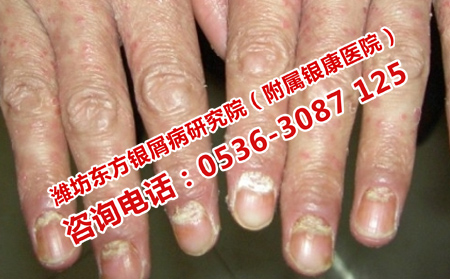 手背牛皮癬瘙癢擴(kuò)散的治療