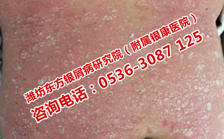 濟(jì)南效果理想的牛皮癬醫(yī)院