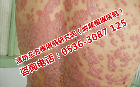 夏天護理膿皰型牛皮癬的技巧