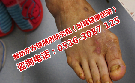 如何治療不嚴重的牛皮癬