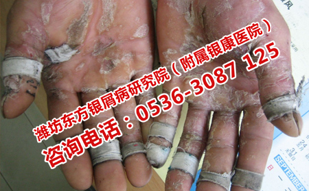 國(guó)外治療牛皮癬的方法