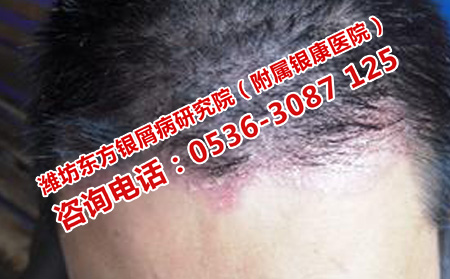頭部牛皮癬怎么洗頭發