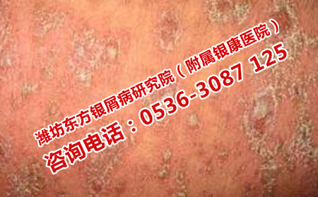濟南牛皮癬患者如何預防