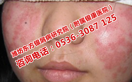 濟南治牛皮癬抗復(fù)發(fā)的醫(yī)院
