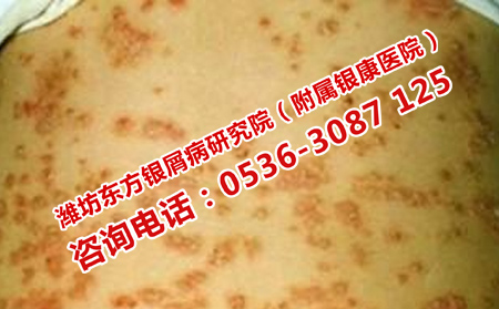防止牛皮癬轉(zhuǎn)型的方法