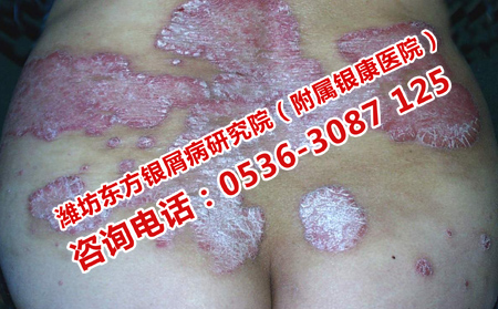 膿皰型牛皮癬的病情發(fā)展