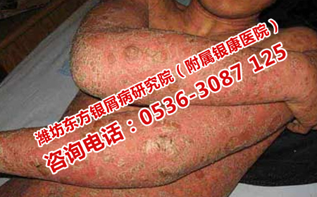 癥狀不嚴重的銀屑病治療