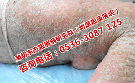 濟南女性牛皮癬專科醫院