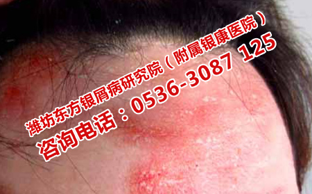 濟南治頭部銀屑病哪里理想