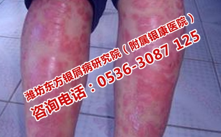 如何預(yù)防銀屑病加重呢