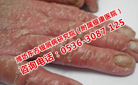 濟南哪里實現銀屑病恢復