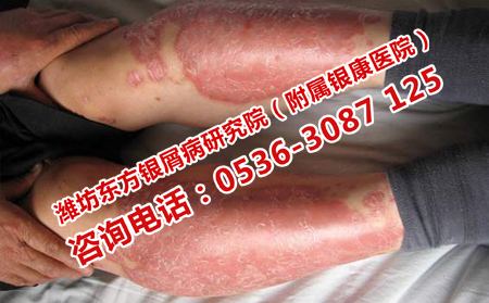 降低銀屑病患者心理危害