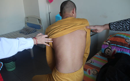 牛皮癬護(hù)理方法